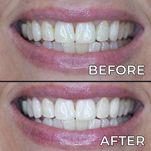 Презареждане на гелевых писалки за избелване на зъбите PerioSciences - Подобрява външния вид на петна и помага да избелите
